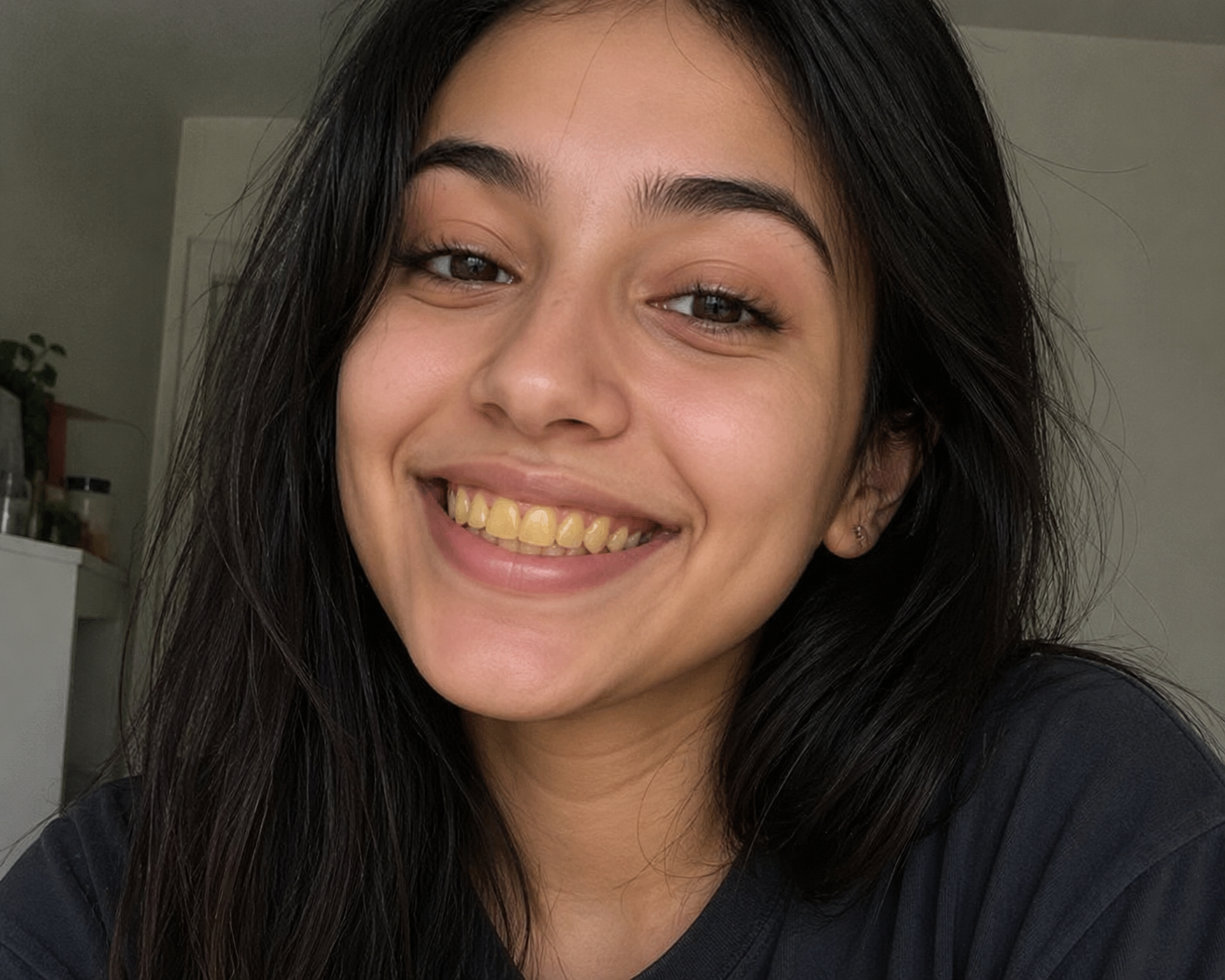After dental treatment – beautiful smile transformation